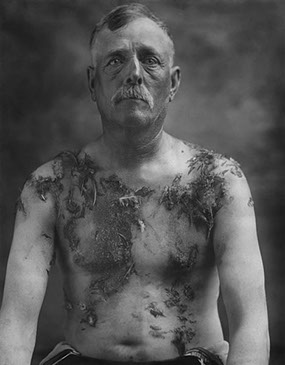 John Meintz Was Tarred and Feathered for Not Supporting War Bond Drives